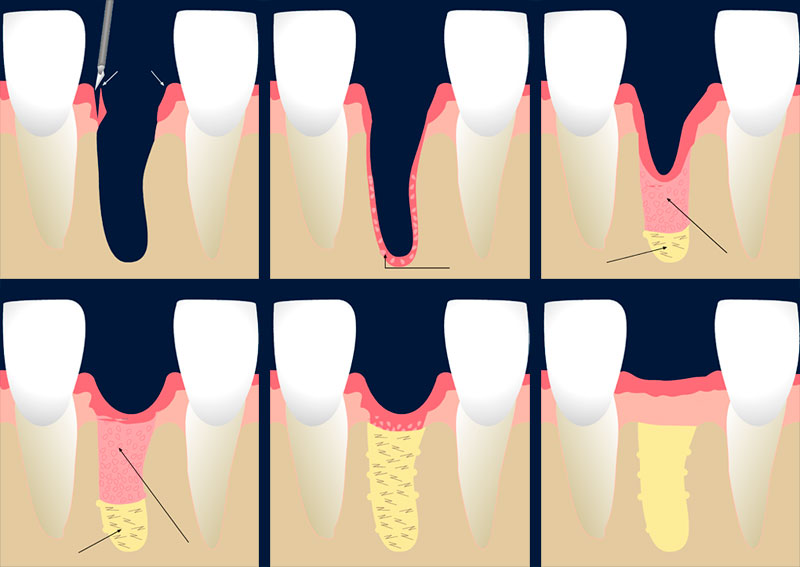Zahnfleisch züchten als Basis für ein fest sitzendes Implantat. Grafik © Hediye Hackenberg