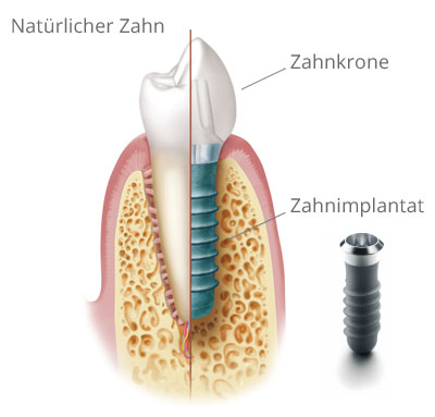 Querschnitt: Natürlicher Zahn und Implantat mit Krone. Grafik mit Materialien © Institut Straumann AG, 2013