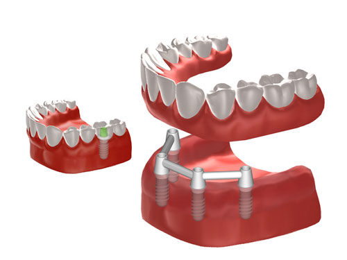 Grafik Implantate zur Befestigung einer Vollprothese und einer einzelnen Krone. © Institut Straumann AG, 2013