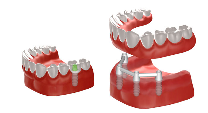 Grafik Implantate zur Befestigung einer Vollprothese und einer einzelnen Krone. © Institut Straumann AG, 2013