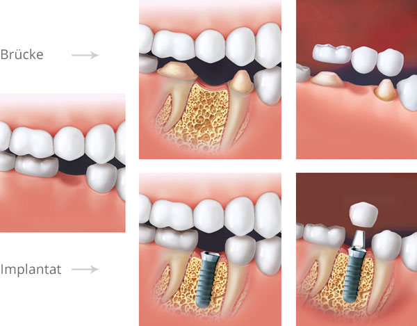 Lösung bei Verlust eines Zahnes: Brücke über zwei beschliffene Zähne oder Implantat mit Einzelkrone. Grafik mit Materialien © Institut Straumann AG