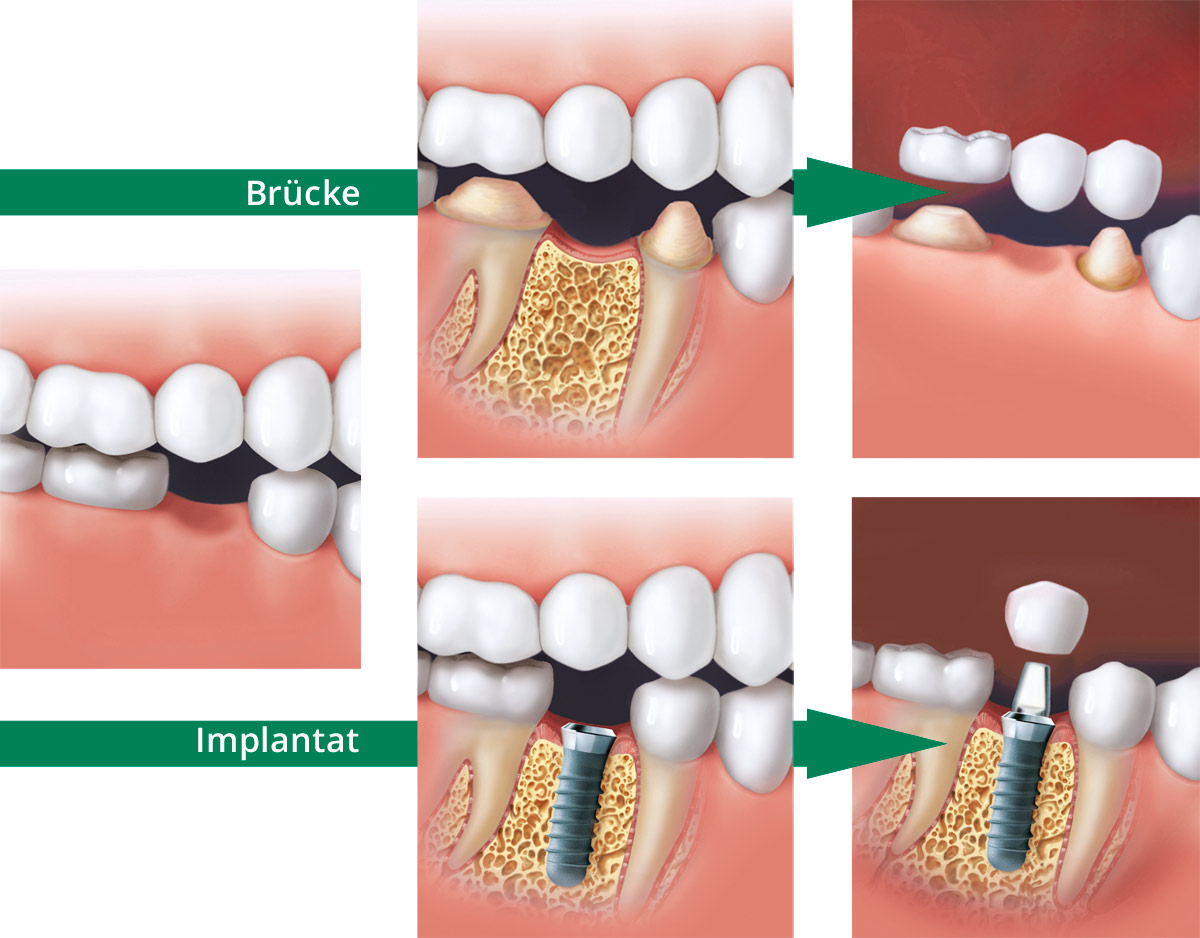 Lösung bei Verlust eines Zahnes: Brücke über zwei beschliffene Zähne oder Implantat mit Einzelkrone. Grafik mit Materialien © Institut Straumann AG
